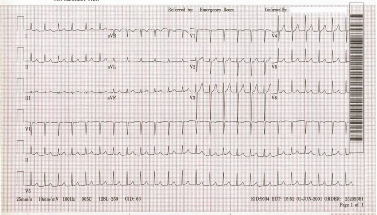 Supraventricular Tachycardia and Driving: Safety Tips and Guidelines